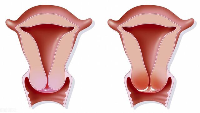 女性的宫颈口图片,请问正常的子宫是什么样子的