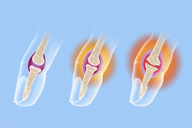 急性手指关节炎怎么治疗:手指关节肿、胀、痛，吃什么药好？