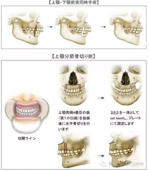 哪个明星没整过容:Angelababy到底整容没？