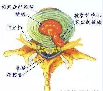 颈椎病会引起整天没精神吗:颈椎病手脚麻木无力会瘫痪吗？