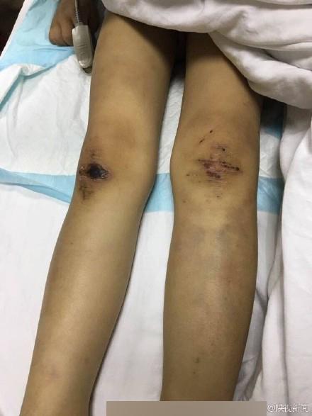 阿娇头部受重伤被送医:黑龙江女童遭继母虐打亲父虐待，生命垂危，他们心为何这般狠毒？