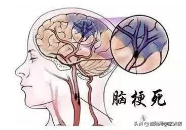 为啥长期脑供血不足会得脑梗塞:颈椎引起的脑供血不足会得脑梗塞