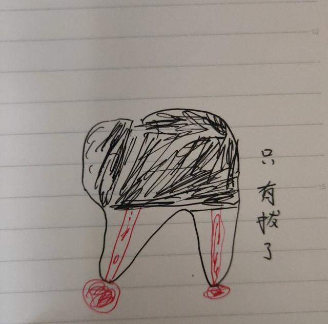 潘阳死了是真的吗:牙齿上出现一个大洞，有人说补了要烧神经牙齿就死了，是真的吗？