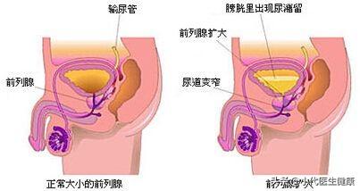 急性泪囊炎是如何引起的，急性前列腺炎是怎么引起的