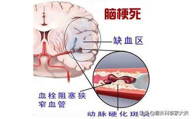 为啥长期脑供血不足会得脑梗塞:颈椎引起的脑供血不足会得脑梗塞