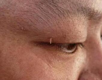 脖子上不断长出“小肉球”,可以用手抠掉吗？是HPV感染引起的吗？