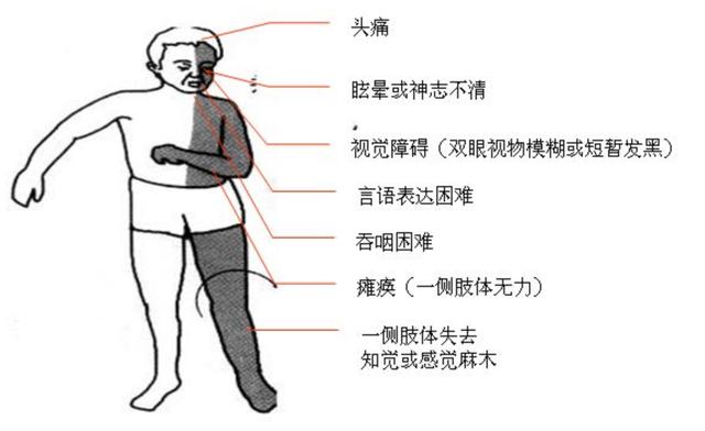 头条问答 - 生活感悟,如何及时发现脑卒中症状?(3个回答)