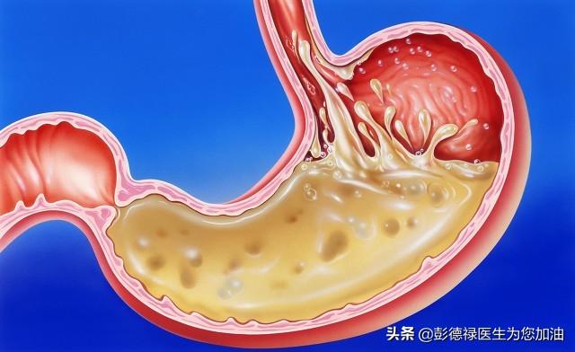 复方消化酶胶囊是胃动力药吗:经常性打嗝的原因是什么？偶尔还反流，什么办？