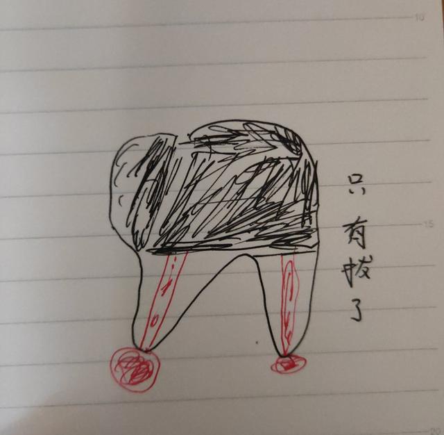 臼齿:臼齿可以拔吗 上牙第一颗臼齿烂透了，只剩半个发黑牙外壳，有必要拔牙吗？