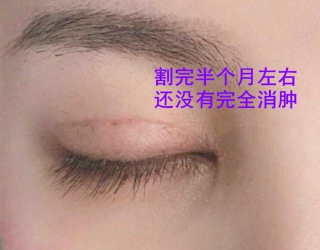 戚薇回应割双眼皮:你会怎么看待割了双眼皮的异性，如果是自己男/女朋友呢