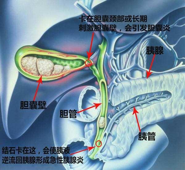 胆结石多大算严重？-每天讲糖的回答-头条问答