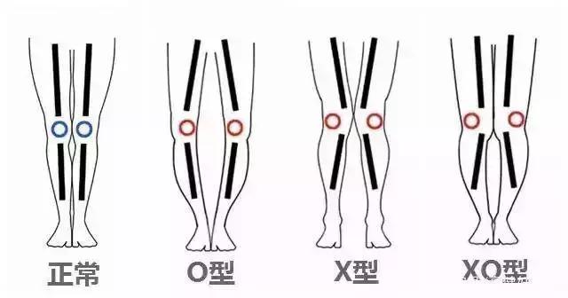 怎么矫正XO型腿，女生的哪些腿型，夏天的时候最好不要露出来