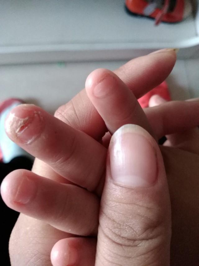 头条问答 - 5岁半的宝宝老是啃指甲,甚至把手指头都咬烂了,该怎么办?