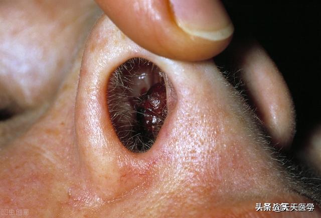 人鼻腔结构图:鼻腔异物五花八门，如何正确清除？