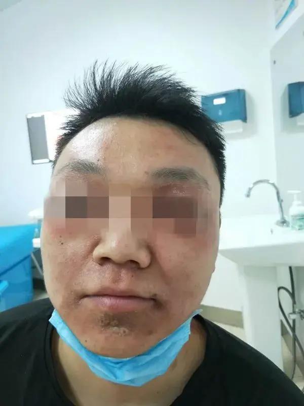 隐翅虫图片:为何最近人民日报发布了隐翅虫相关的提醒？