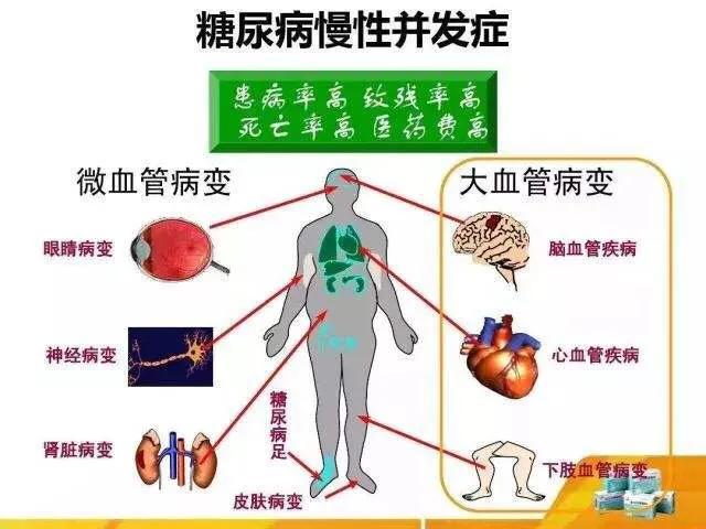 末梢神经炎:什么是糖尿病性末梢神经炎？