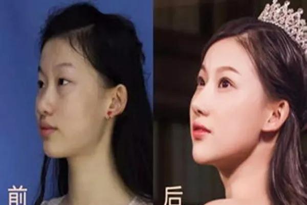 祁可欣整容:19岁女孩花百万整成刘亦菲，名字也改一样，如今怎样了？