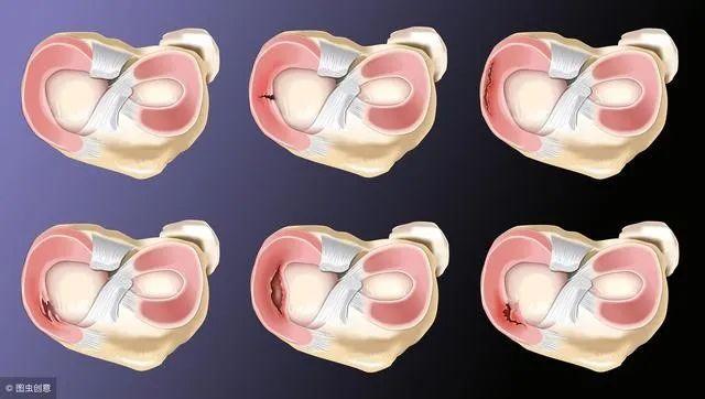半月板损伤症状:半月板损伤是一种什么样的体验？
