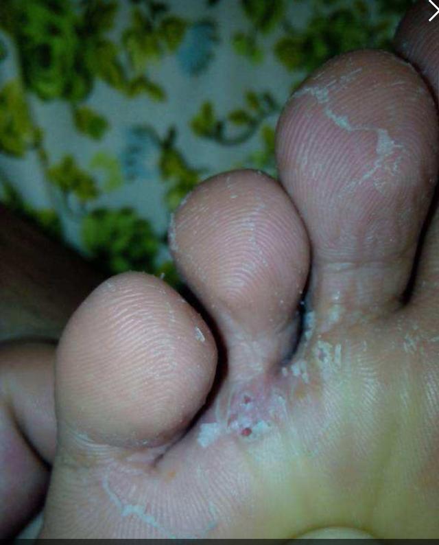 头条问答 - 脚气的症状图?(2个回答)