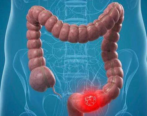 一做ct,考虑肠梗阻,结肠肿瘤的可能性大.