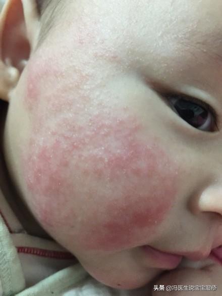 宝宝得湿疹怎么办，婴儿湿疹怎样好得快？