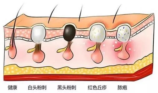 黑头的形成过程是啥样的，为什么鼻子长黑头不能用手挤有什么科学依据吗如何才能正确去黑头