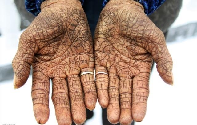 头条问答 - 手干裂到出血,有什么好的解决办法?(5个回答)