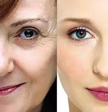 脸上长皱纹怎么办怎样去皱纹吗