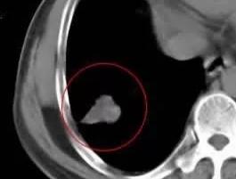 gimpet猫窝:肺结节恶化都有哪些表现？