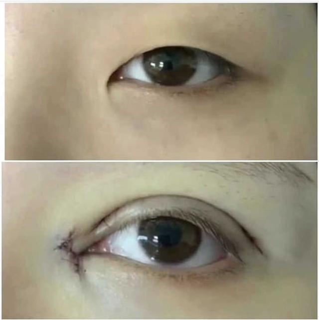 戚薇回应割双眼皮:你会怎么看待割了双眼皮的异性，如果是自己男/女朋友呢