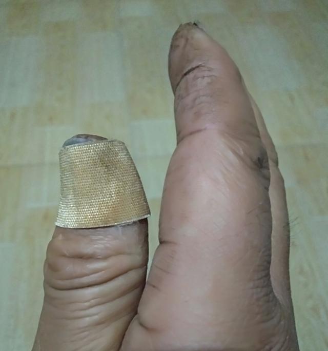 头条问答 - 手裂口子可以用纱布包扎吗?(282个回答)