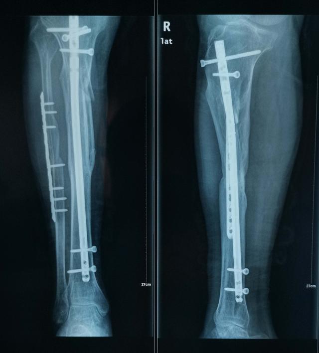 胫腓骨骨折长得慢怎么办:胫腓骨双骨折内固定手术三个月了居然还没长好，什么问题？