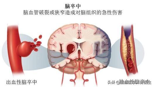 瘫痪是什么意思:我爸现在半边瘫痪了，是哪种类型的病？