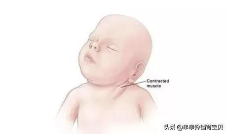一个月宝宝歪头睡怎么办?-育儿网