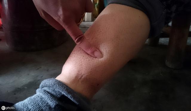 尿酸过高是尿毒症前兆吗:体内尿酸超标时，身体是如何通过外在表现告诉我们的？