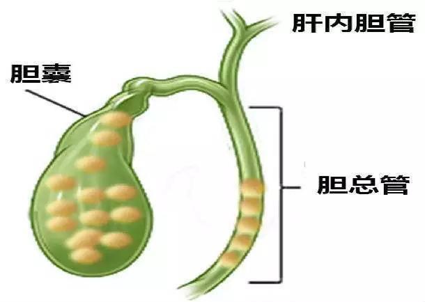 胆结石多大算严重？-每天讲糖的回答-头条问答