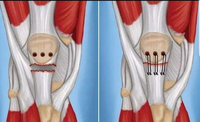 头条问答 膝盖上方肌腱断裂硬硬的还肿 怎么办 1个回答