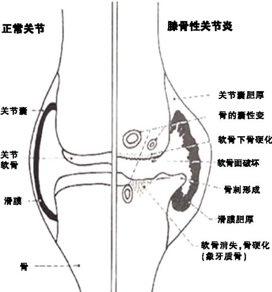 膝盖软骨磨损和风湿什么区别:软骨磨损是不是由风湿引起的 怎样区分骨关节炎、风湿性关节炎、类风湿关节炎？