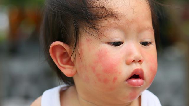 治疗儿童荨麻疹最好的方法是什么？