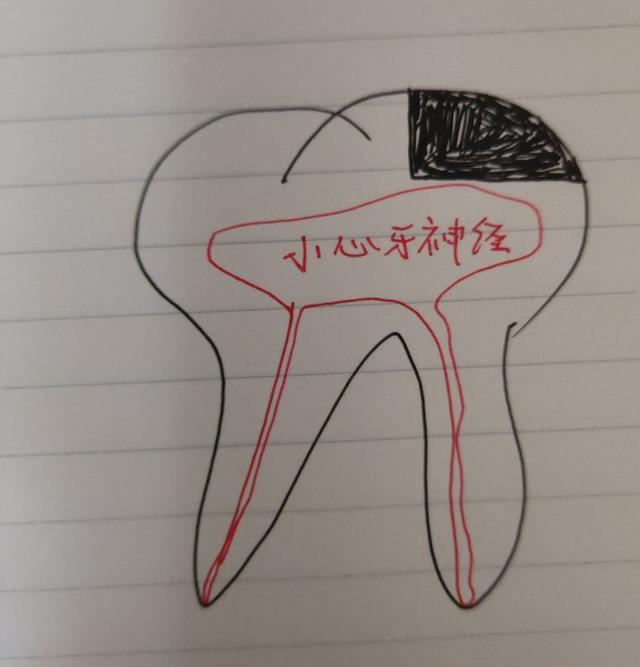 臼齿:臼齿可以拔吗 上牙第一颗臼齿烂透了，只剩半个发黑牙外壳，有必要拔牙吗？