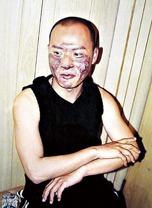 任家萱烧伤图片:范玮琪摔伤下巴缝了15针，如何看待明星网上晒受伤的行为