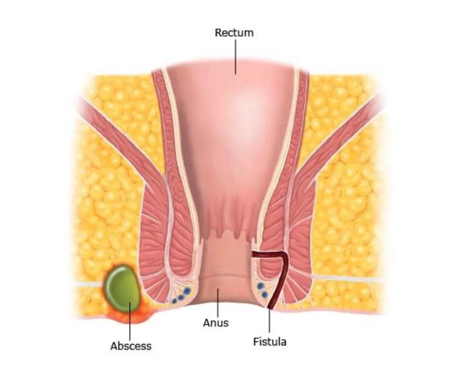 作为体检项目肛门指检到底有没有用
