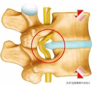 肌肉注射的注意事项:腰间盘突出打针期间要不要练腰背肌？