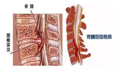 颈椎病会引起整天没精神吗:颈椎病手脚麻木无力会瘫痪吗？