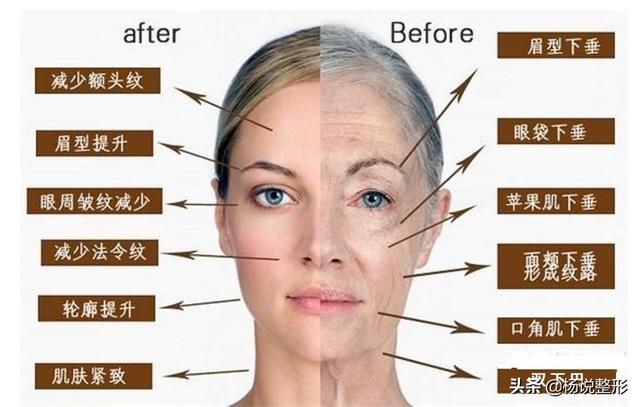 线雕治疗项目埋线过程示意图线雕术前术后对比图不管你是18岁还是48岁