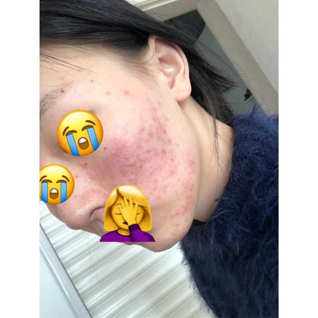 刷酸什么意思刷酸的流程是怎么样的怎么样的皮肤适合刷酸