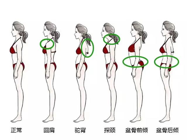 骨软骨病x线特征:骨软骨瘤x线表现是什么 为什么驼背这么“舒服”？