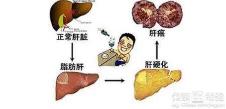 罗汉鱼腹水症状:腹部积液会有什么症状？是什么原因导致的？