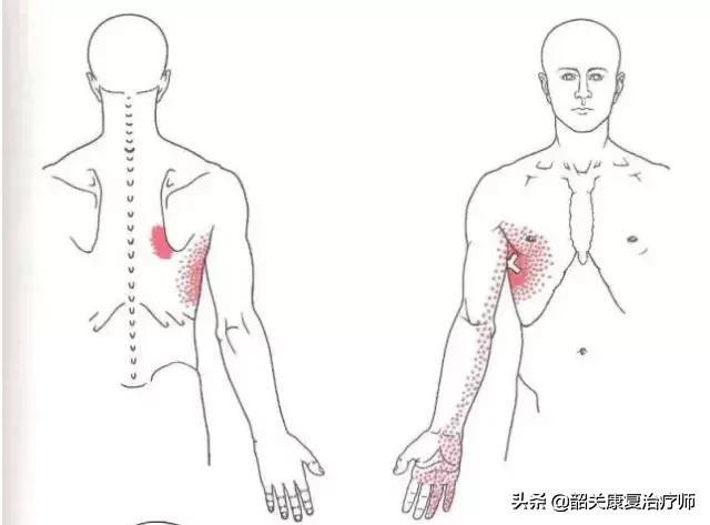 头条问答 - 左肩胛骨疼痛是怎么回事?(2个回答)