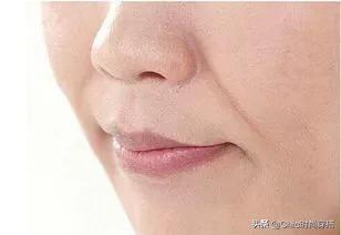 法令纹深:法令纹和抬头纹突然变得很深，看起来老了十岁，该如何改善
